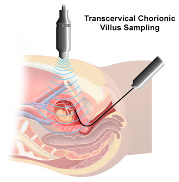 <p><span>&nbsp;</span><span style="font-family: "Tw Cen MT";">A catheter (flexible hollow tube) is inserted into the chorion through the maternal vagina during weeks 9 - 19.</span></p><p><span>&nbsp;</span><span style="font-family: "Tw Cen MT";">A specimen of foetal cells is obtained from the chorion (one of the foetal membranes) and analysed as in amniocentesis.</span></p><p><span>&nbsp;</span><span style="font-family: "Tw Cen MT";">Analysis can be done quicker than with amniocentesis but the risk of miscarriage is 1%.</span></p><p><span>&nbsp;</span><span style="font-family: "Tw Cen MT";">Spina bifida cannot be detected by CVS.</span></p><p><span style="font-family: "Tw Cen MT";">&nbsp;</span></p>