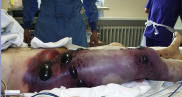<p>Fast onset; watery diarrhea and ion loss; resolves within a couple days Gas gangrene (myonecrosis): spores in deep wound, alpha toxin (lecithinase activity) - progresses fast → crepitus under skin, purple bullae with discoloration</p>