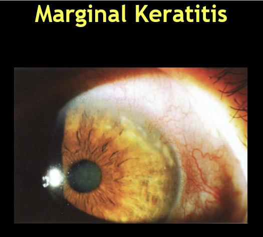 <ul><li><p>Anterior blepharitis (Staph bleph)</p></li><li><p>Acts as the source of staph exotoxins</p></li><li><p>Underlies recurrence if lid disease is untreated</p></li></ul><p></p>