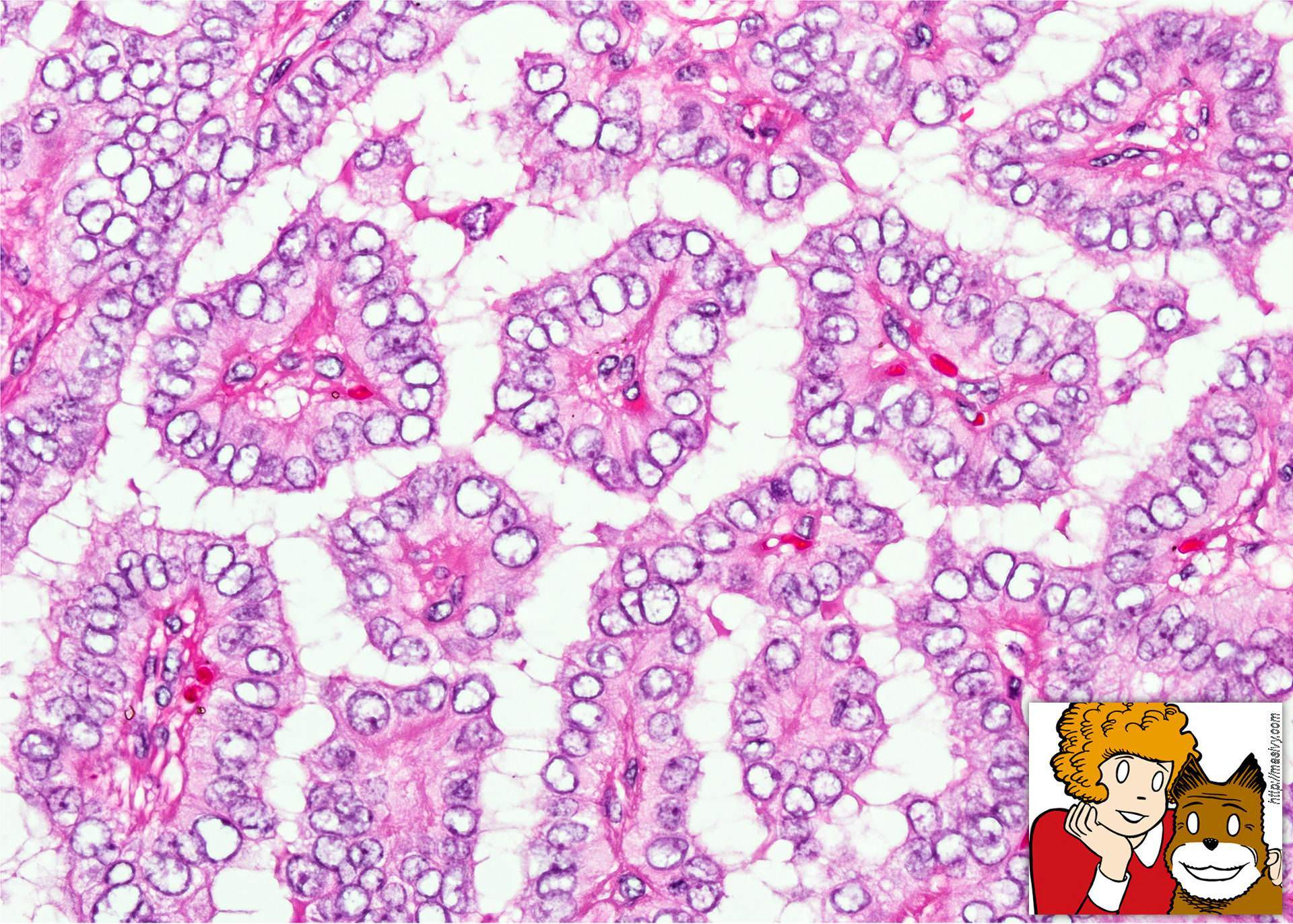 <p></p><ul><li><p><strong>Orphan Annie eye nuclei</strong> → clear/empty-appearing nuclei </p></li><li><p><strong>Psammoma bodies</strong> → laminated calcifications </p></li><li><p>Nuclear grooves </p></li><li><p>Intranuclear cytoplasmic inclusions </p></li><li><p>Papillary architecture</p></li></ul><p></p>