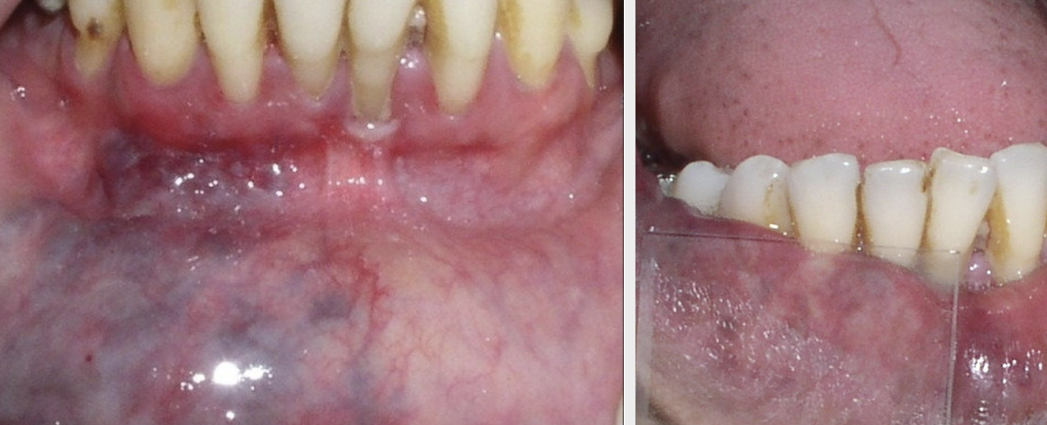 <p>used to determine if a lesion is caused by blood within vessels (erythema) or hemorrhage (petechiae/purpura); plastic slide is pressed against lesion to produce temporary blanching by forcing blood out of superficial tissues </p>