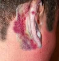 <p><mark data-color="#ffe3af" style="background-color: rgb(255, 227, 175); color: inherit;">Manifestation</mark></p><p>A nurse assess bruising over the mastoid process of the ears, what is the condition called </p><p></p>