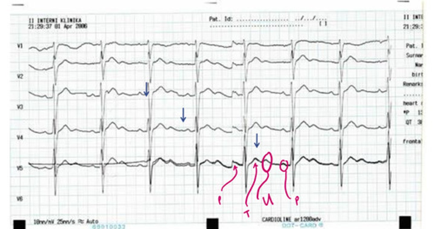 <p>this is an example of _______, which has characteristic ___ waves</p>