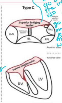 <p>The superior bridging leaflet is:</p><ol><li><p>Undivided</p></li><li><p>Not attached to the ventricular septum</p></li><li><p>Free floating over the bridging leafelt</p></li><li><p>Attached to an RV free-wall papillary muscle</p></li></ol><p></p>