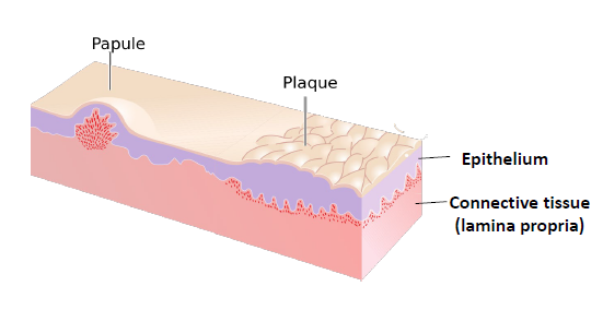 <p>a solid, raised, flat topped lesion greater than 5 mm in diameter </p>