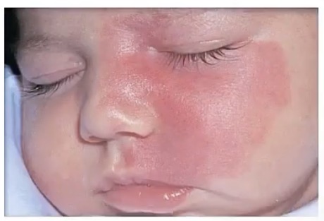 <p>-port wine stain</p><p>-capillaries</p><p>-pink/red patch</p><p>-permanent, grows with child</p><p>-sturge-weber syndrome</p><p>-back of neck or eyelids; temporary</p>