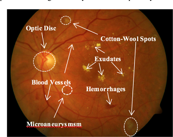 <p>Diabetic retinopathy</p><p>Hard exudates: proteins and lipids that have exudate out of blood vessel</p><p>Cotton wool spots: indicative of ischemia. Yellow/orange and larger than n the hard exudates.</p><p>Hemorrhages: where blood has leaked into the retina ( shadow looking)</p>