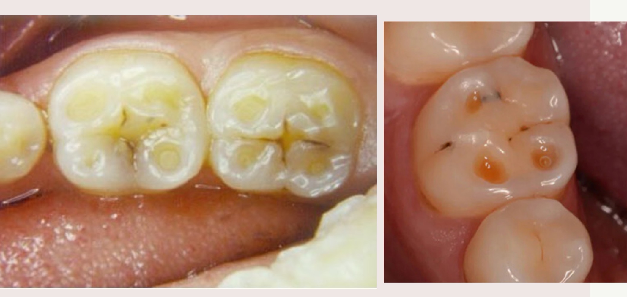 <p>Wear facets which look like "tide pools”</p>