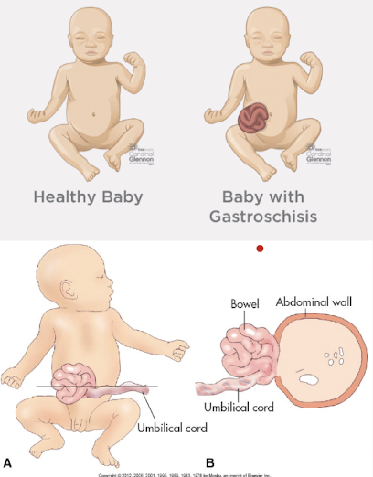 <ul><li><p>periumbilical opening in abdominal wall</p><ul><li><p>allows for protrusion of bowel through the defect</p></li><li><p>herniation of bowel and, infrequently, stomach and genitourinary organs (rarely the stomach)</p></li></ul></li><li><p>defect is nearly alw<span style="color: rgb(255, 255, 255);">ays to the</span><span style="color: red;"> <u>right</u> of the umbilical cord</span></p></li><li><p>umbilical cord insertion is normal</p></li><li><p><span style="color: red;">no skin or membrane covering the defect or herniated contents</span></p></li><li><p><span style="color: red;">AFP levels are significantly higher</span> compared to omphalocele</p></li></ul><p></p>