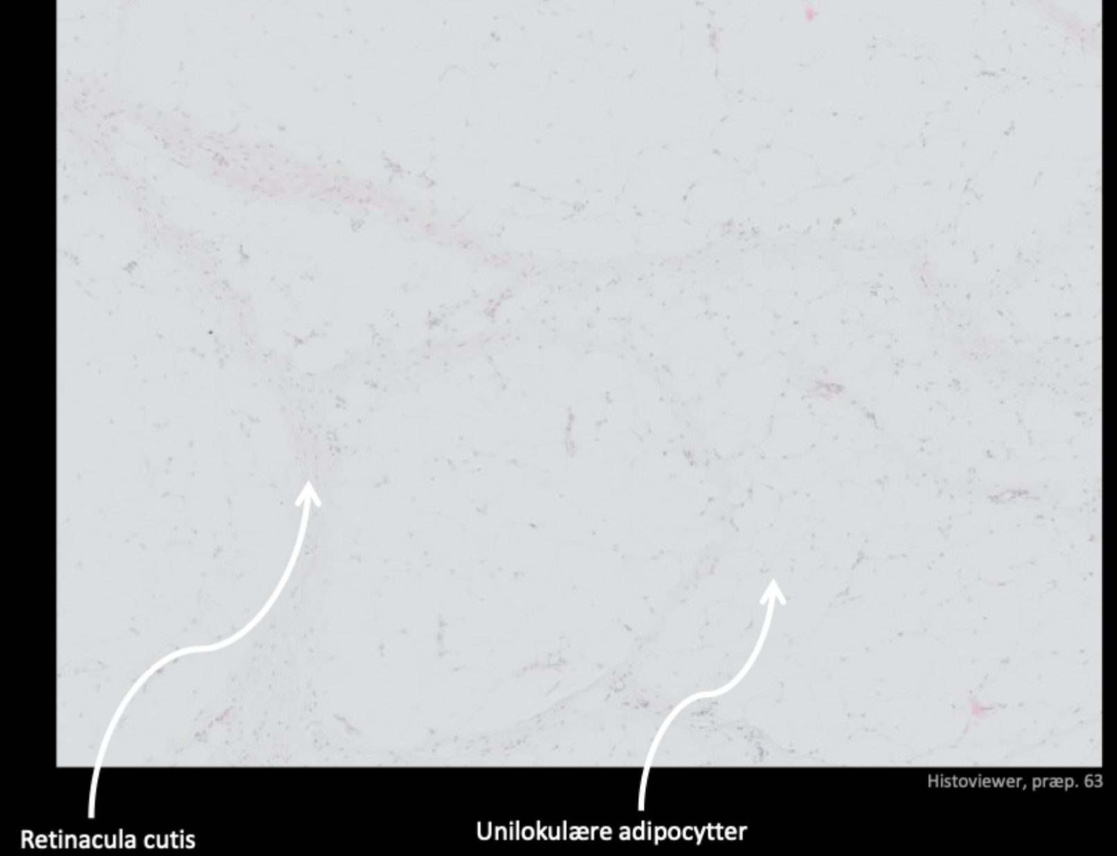 <p>Retinacula cutis og unilokulære adipocytter</p>