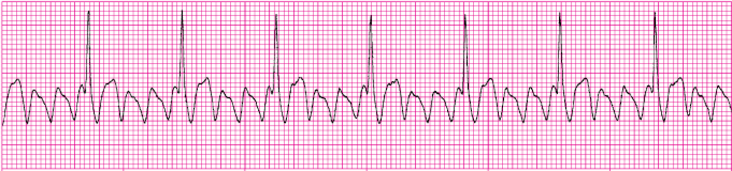 <p>What ECG is this? </p>