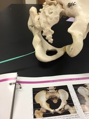 <p>Lateral to the obturator foramen</p>