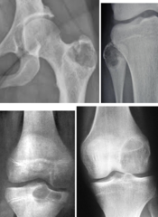 <p>What is this?</p><p>- 10-25 yo, Male</p><p>- Pain (referred to adjacent jt)</p><p>- Epiphyseal/ Apophyseal - knee, hip, shoulder</p>