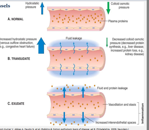 <p>Blood vessels change in order to allow <strong>plasma proteins and cells out of the circulation into the site of the stimulus</strong></p><p>• Release of excess fluid into tissue or body cavities is called <strong>oedema</strong></p><p>• Release of fluid and cells from the circulation is called <strong>exudation </strong>(rich in leukocytes)</p><p>— An exudate is an extracellular fluid rich in protein and containing cells</p><p>— Has a high specific gravity</p><p>— Pus (purulent exudate) is rich in leukocytes (mainly neutrophils), debris of dead cells +/- microbes</p><p></p><p>• Ultrafiltrates of plasma (i.e. no increased vascular permeability) are caused by loss of osmotic pressure or high hydrostatic pressure</p><p>— Creates a transudate with low protein content and little or no cellular material</p><p>— Has a low specific gravity</p>