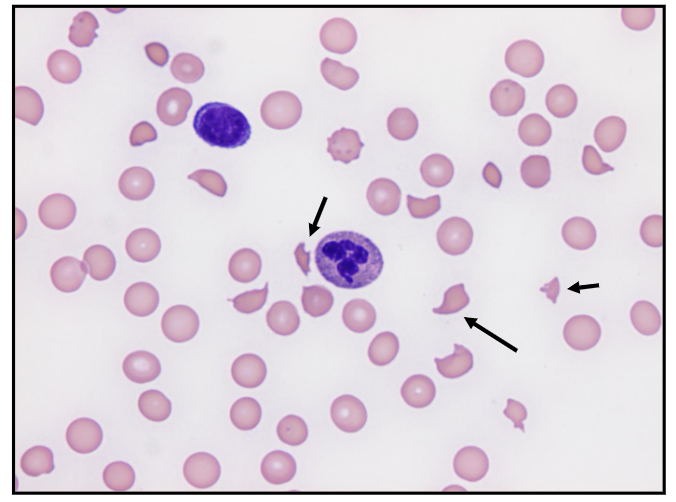 <p>Sepsis can cause haemolytic anaemia</p>
