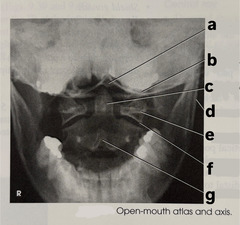 <p>label (a-c) open mouth atlas and axis</p>