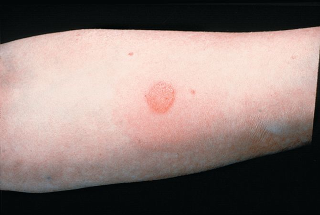 <p><span>walls off intracellular infectious organisms, preventing the infectious microbe from escaping to infect other cells</span></p>