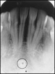 <p>Lingual foramen</p>