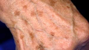 <p><span>Flat, non-palpable, pigmented lesion </span><strong>< 1 cm. </strong></p>