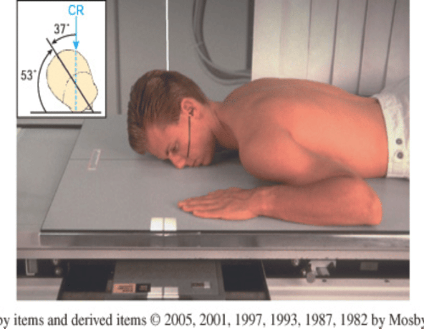 <p>S - around waist</p><p>T - center cell, 75 kVp</p><p>A - none</p><p>M - rt orbit= rt marker on rt side (opposite is true)</p><p>P - chin, cheek, and nose touching IR, AML perp, CR to downside orbit</p><p>S - 40"</p><p>B - hold</p><p>C - 10 by 12, L (collimate to 7 by 7)</p>