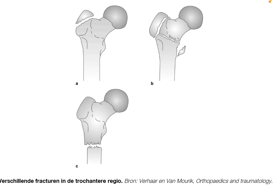 <p>Bevinden zich tussen trochanter major en trochanter minor, ook deze fracturen komen vooral voor bij ouderen. </p><p>Ontstaan: komen voor in corticaal bot, met een spier bedekking. Door spieren kan er gemakkelijk een dislocatie optreden. </p><p>Instabiele fracturen hebben vaak een groot posteromediaal fragment, subtrochanterische extensie en neiging tot inzakken in varusstand. </p>