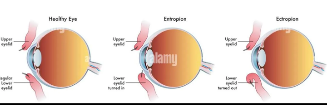 <p><span><strong>Entropion vs ectropion comparison:</strong></span> Entropion = eyelid turned ____; ectropion = eyelid turned ______.</p>