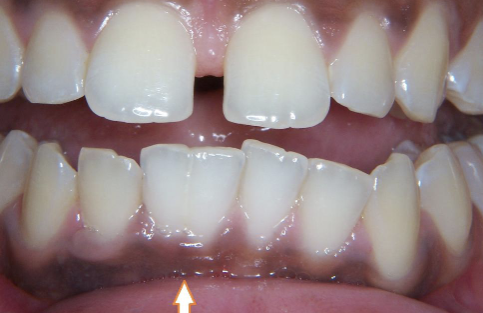 <p>single enlarged/ double/ jointed tooth in which the tooth count is normal (NO MISSING TEETH); one tooth bud tried to divide </p>