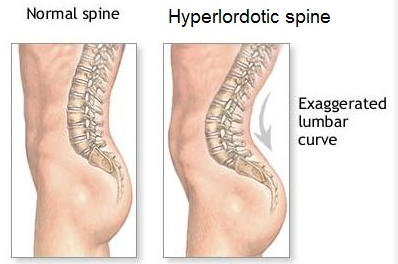 <p>swayback, exagerated inward curve of lumbar spine</p>