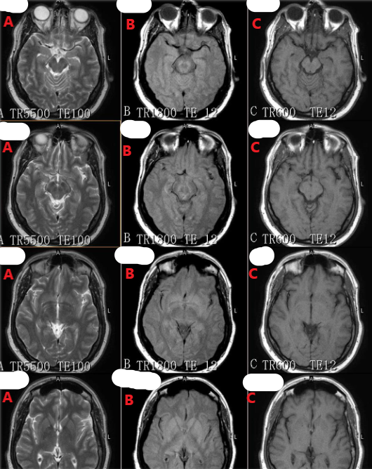<p>Which row of these images are T1 weighted ?</p>