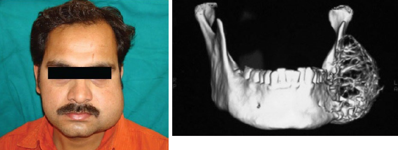 <p>osteosarcoma </p>