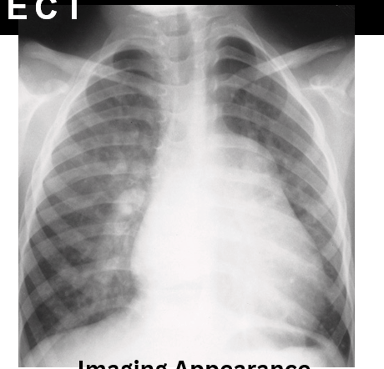 <p>D. CHD ventricular septal defect</p>