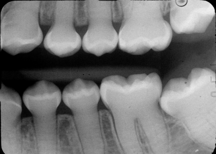 <p>shell tooth</p><p>generally the same as dentinogenesis imperfecta type II except initially have<span style="color: red;"> large pulp chambers </span>that obliterate with age<span style="color: red;"> results to multiple pulp exposure</span></p>