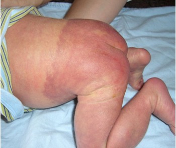 <p>congenital d/o with a triad of capillary malformation, venous malformation, and limb overgrowth </p>