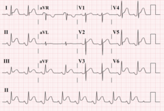 <p>diffuse ST elevation and PR depression</p>