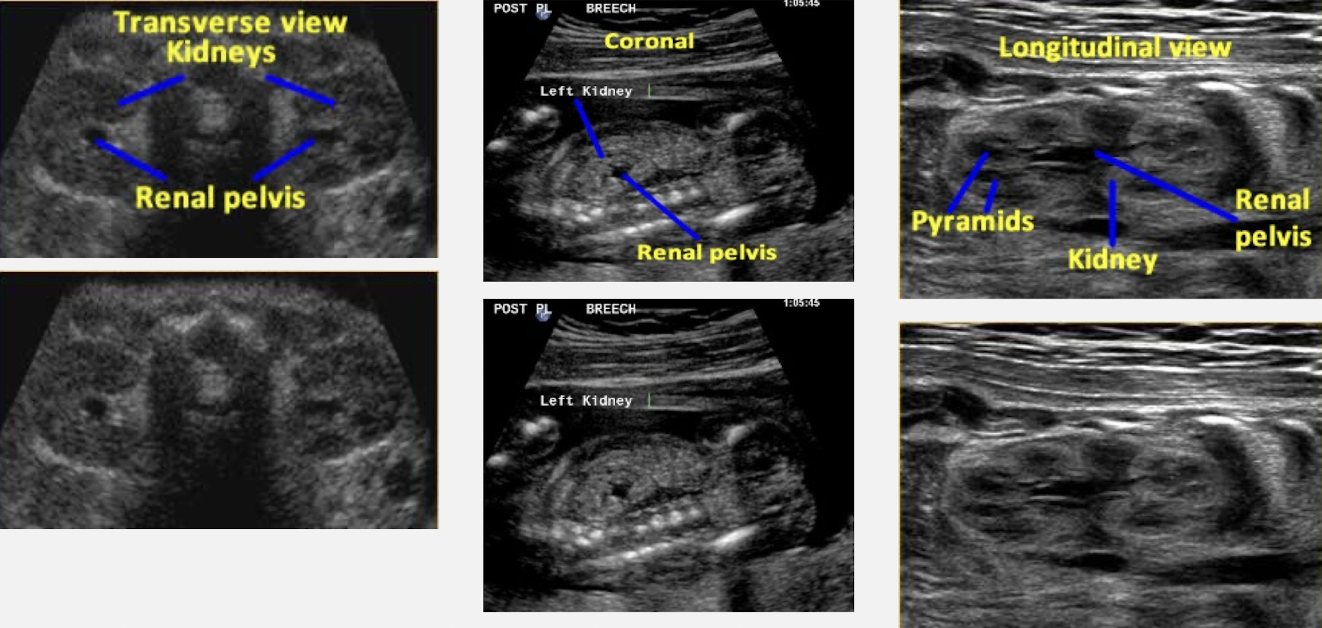 <p>SONO: normal fetal kidneys</p>