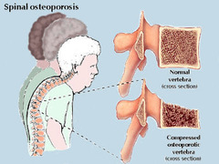 <p>Bones become brittle and fragile from loss of tissue; typically a result of hormonal changes or a deficiency of calcium or vitamin D</p>