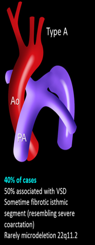 <p>interruption found at isthmus</p><ul><li><p>origin of the subclavian artery and the insertion of the ductus arteriosus </p></li><li><p>distal to left subclavian artery </p></li></ul><p></p>