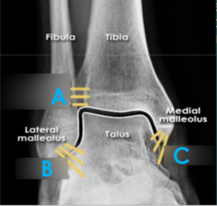 <p>C (ligament)</p>