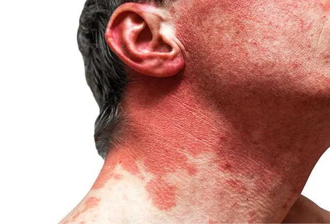 <p>Red rash from rapid IV administration of gentamicin or vancomycin </p><ul><li><p>sx : hypotension , flushing and itching </p></li></ul><p></p>