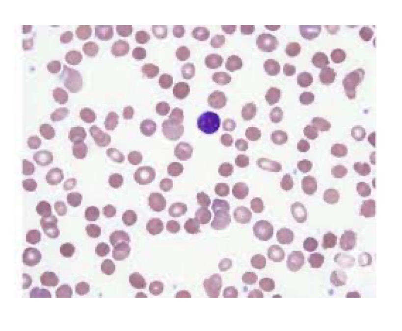 <p>What is hereditary spherocytosis</p>