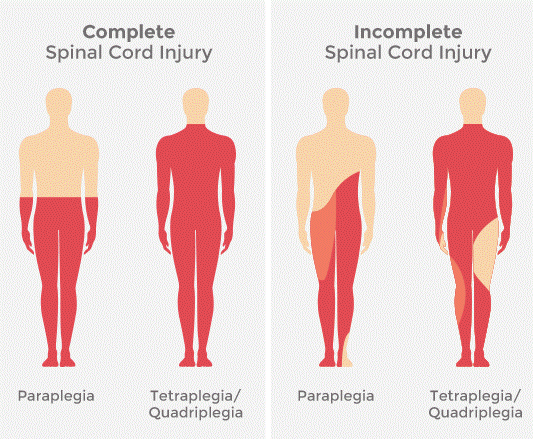 <p>Total loss of sensory &amp; motor function below the level of injury</p>