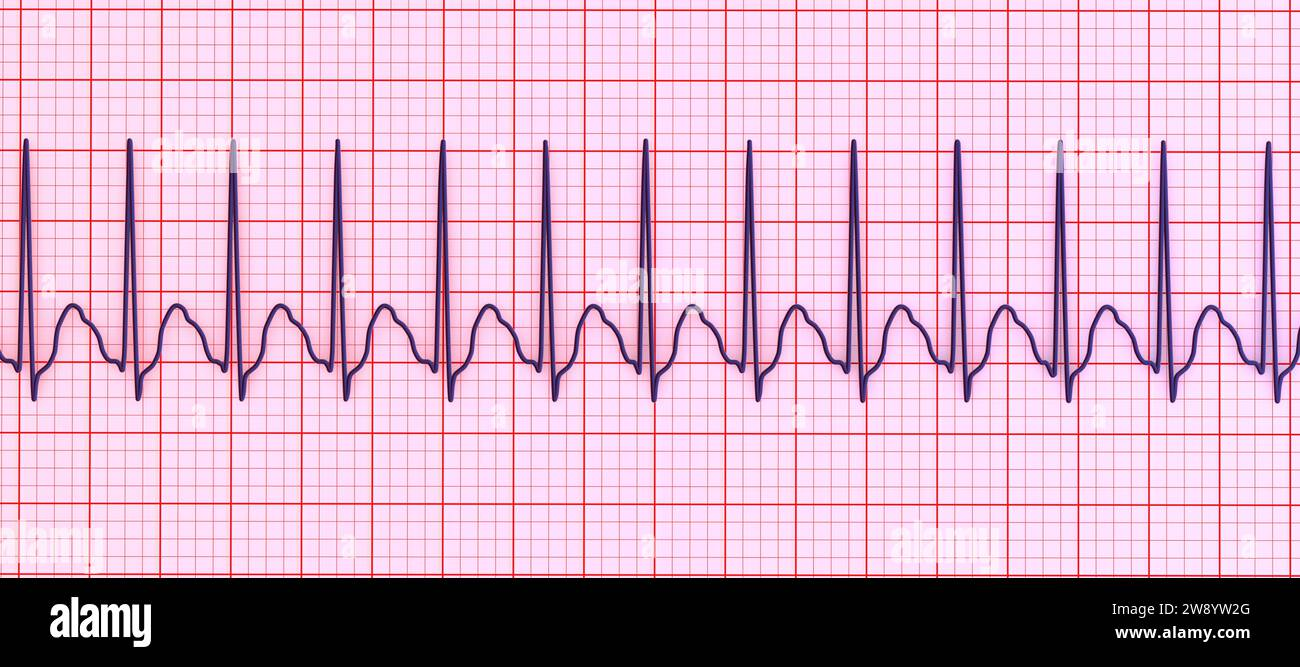 <p>Rate: 180-250</p><p>Regularity: regular </p><p>Can’t determine P waves</p>