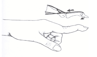 <p>Swan Neck Deformity </p>