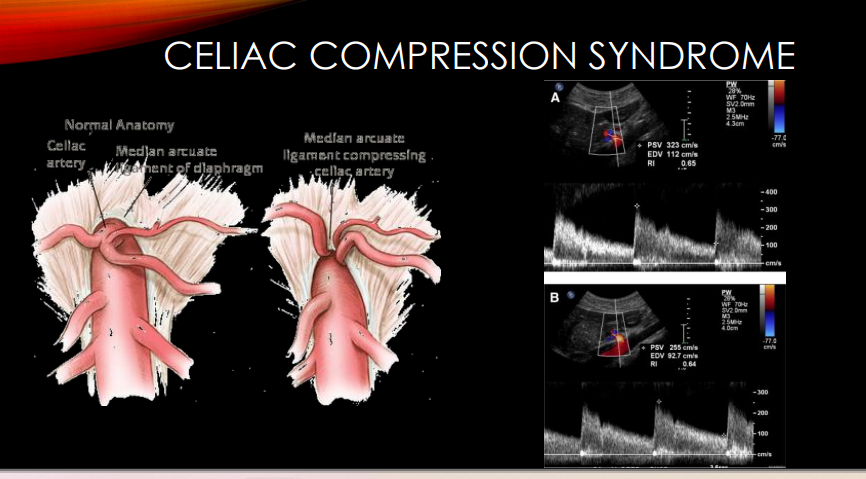 <p>What breathing maneuvers are used during MALS evaluation?<br>→ Inspiration and expiration imaging</p><p>What body position may normalize the waveform in MALS?<br>→ Upright position</p><p>What appearance does the celiac artery origin have in MALS?<br>→ Hook-like appearance on 2D imaging</p>