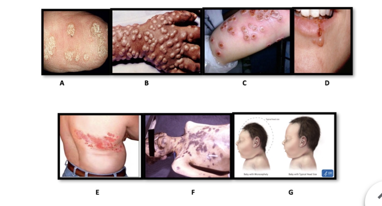 <p><strong><span>Identify the disease underneath each condition. &nbsp;</span></strong></p><p><strong><span>-picture G</span></strong></p>