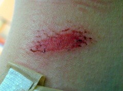 <p>only epidermis</p><p>minor wounds that affect the outermost layers of skin and include minor cuts and scrapes</p><p>heal very well, minimal blood loss,less infection</p>