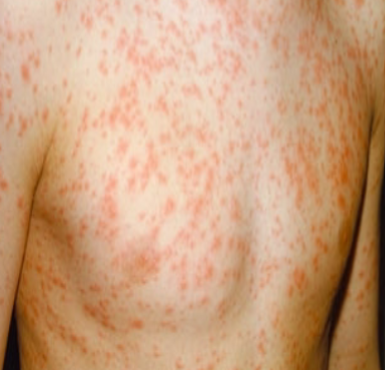 <p>Rubella (German Measles) sx*</p>