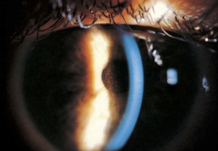<p>Pigment can also accumulate on the iris surface, in addition to the corneal endothelium and trabecular meshwork.</p>