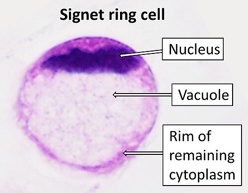 <p>Hemosiderinophage vs Signet-Ring Macrophage</p>