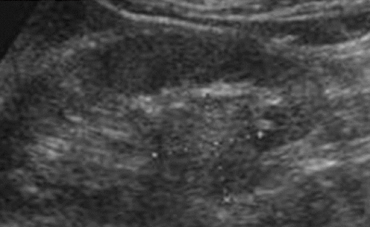 <p>extremely difficult to differentiate from RCC </p><ul><li><p>hypoechoic in 50% of cases </p></li><li><p>spoke wheel with central scar </p></li></ul><p></p>